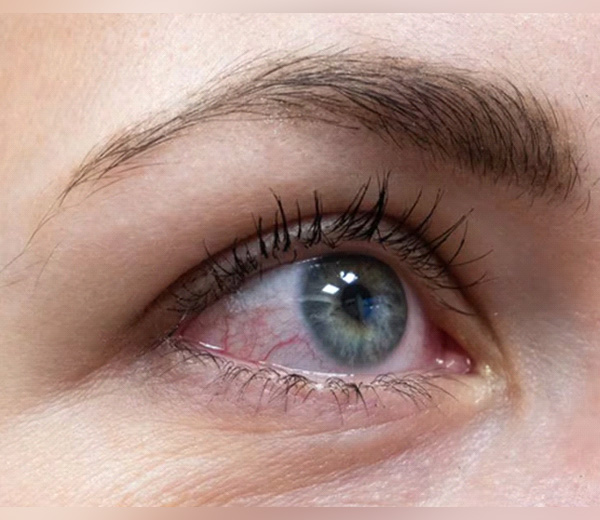 Irritación, enrojecimiento o sequedad en los ojos